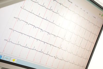 Präventions-Check: EKG (Elektrokardiogramm)